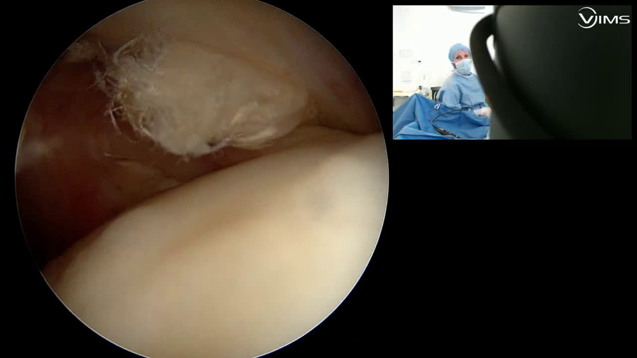 Réparation d’une rupture isolée du supra-épineux de l'épaule sous arthroscopie en double rang (Dr. Joudet)