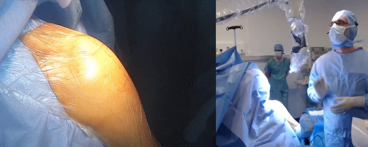 Affinis short prosthesis with Dr Angelo from Portugal (Dr. Joudet)