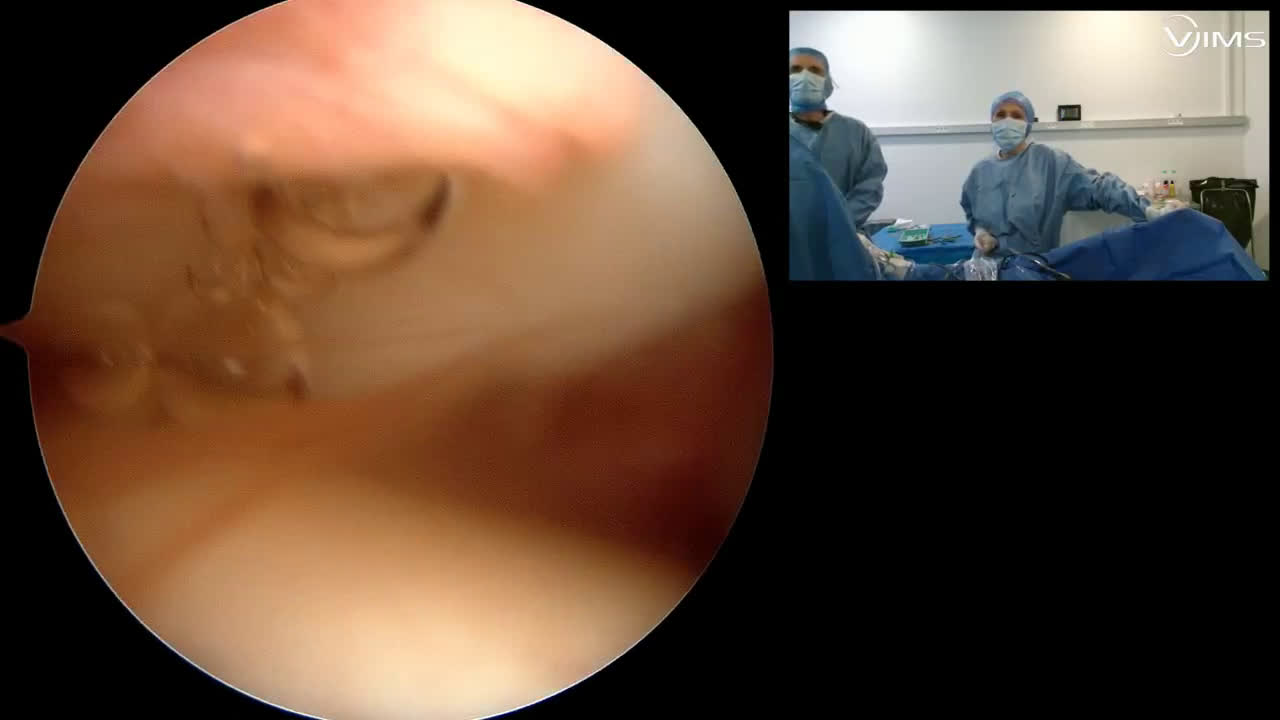Réparation arthroscopique « all in the box » d’une rupture du tendon du sous-scapulaire de l’épaule (Dr. Joudet)