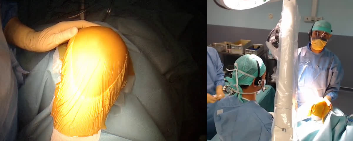 Dr. Abdou Sbihi - Total Knee Arthroplasty (with Toan Ngo Ba) - ICOS ( Clinique Juge)