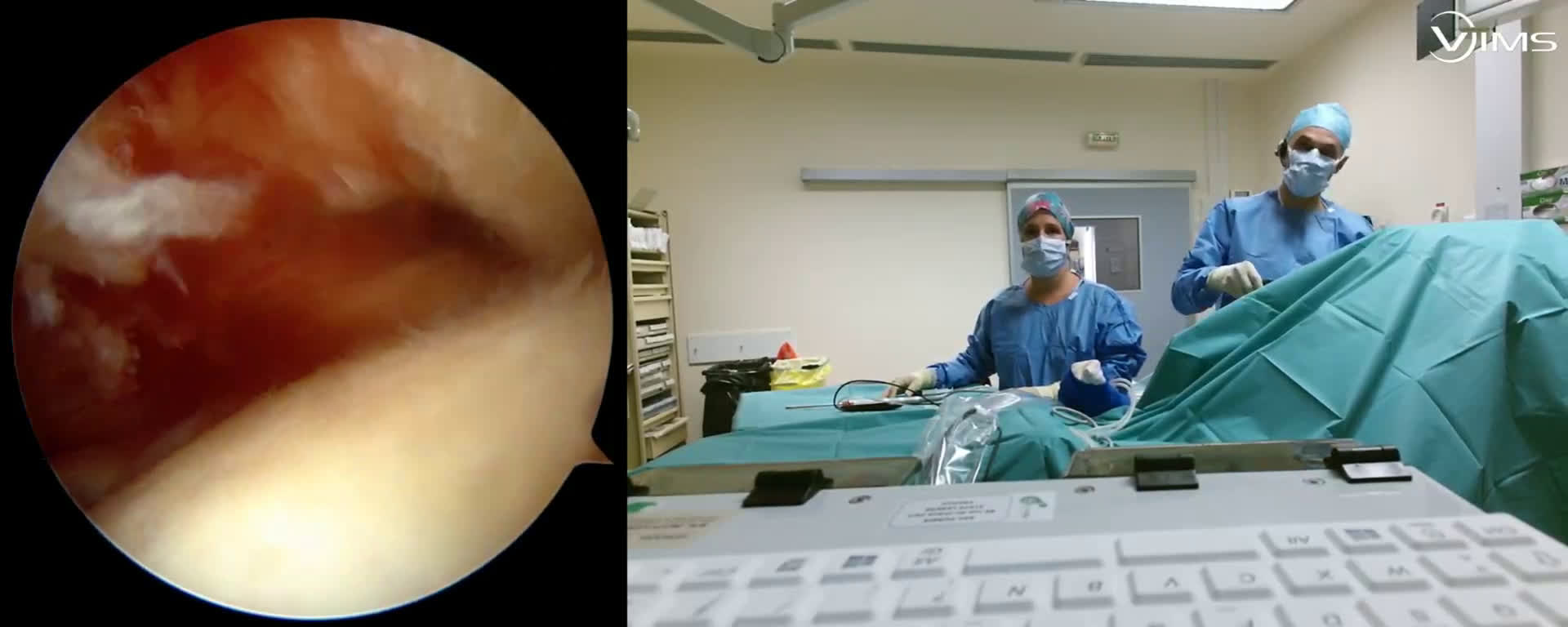 @Transosseous cuff repair: subscapularis and supraspinatus (Dr. Kany)