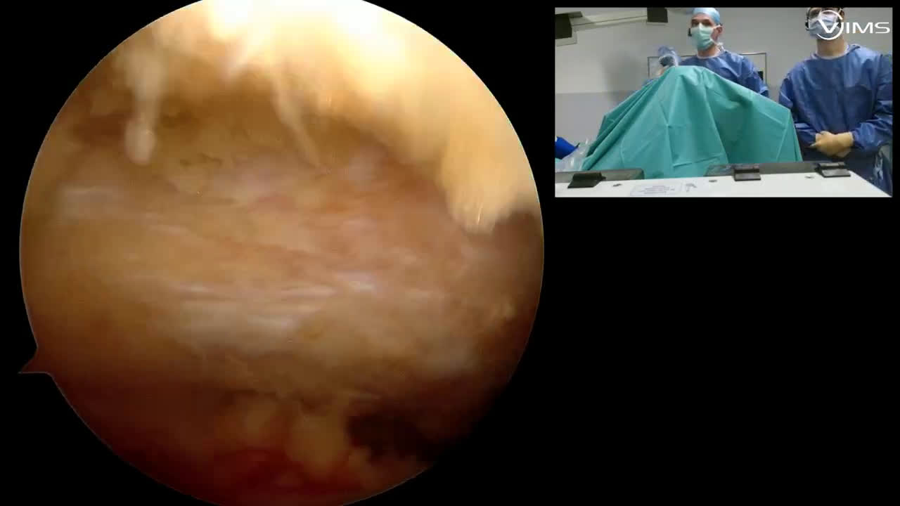 @Weaver-Dunn procedure with Dr Vincent Salabi: the Vims experience (Dr. Kany)