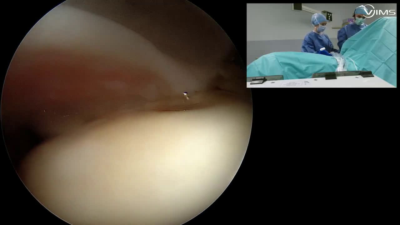 @55mn for a full combined LDTM Tendon transfer for a post Sup Cuff deficiency (Dr. Kany)