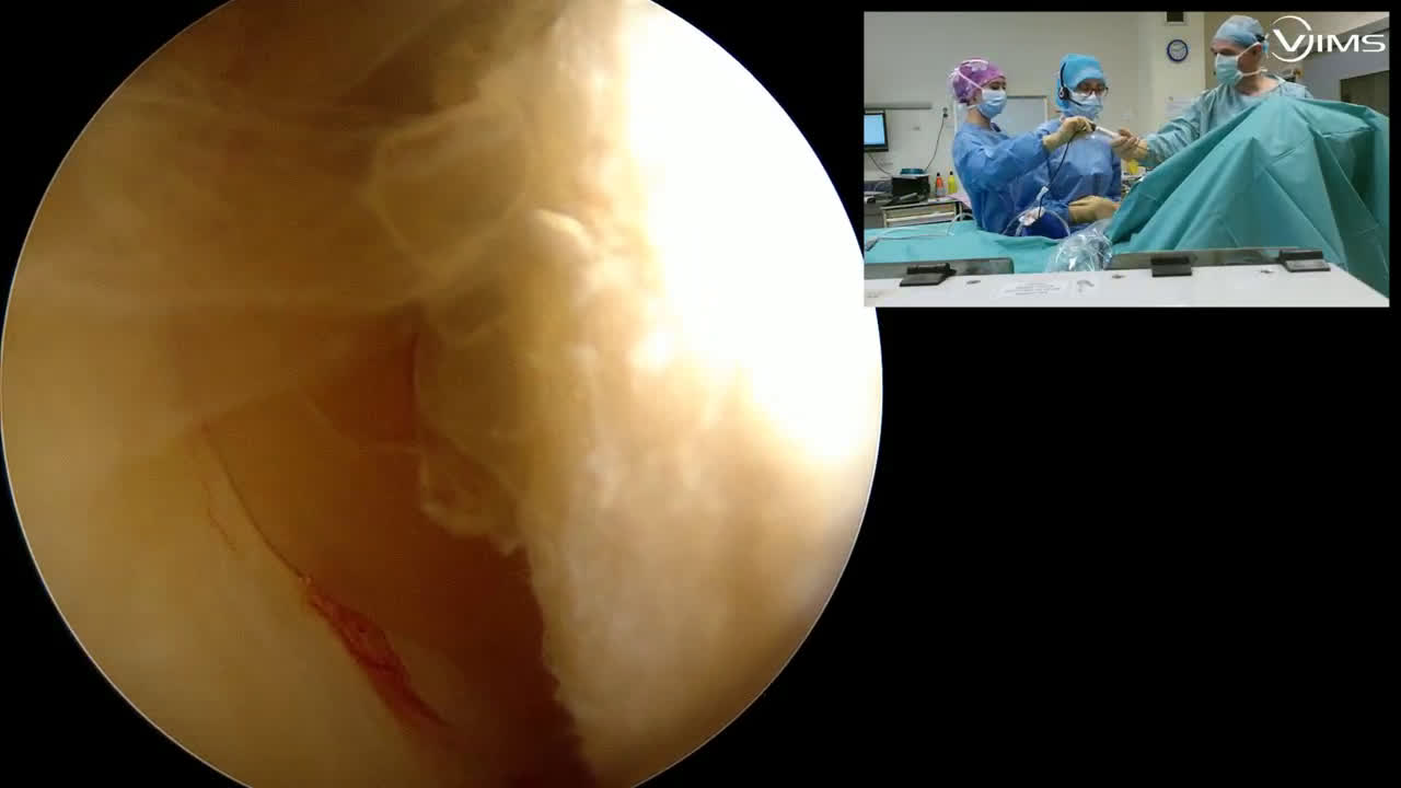 @Massive cuff tear with comma sign (Dr. Kany)