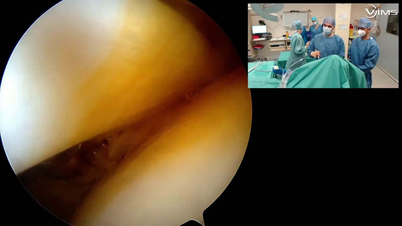“@Biceps SCR with partial ant and post repair” with Dr Jigar Patel from Mumbai (Dr. Kany)