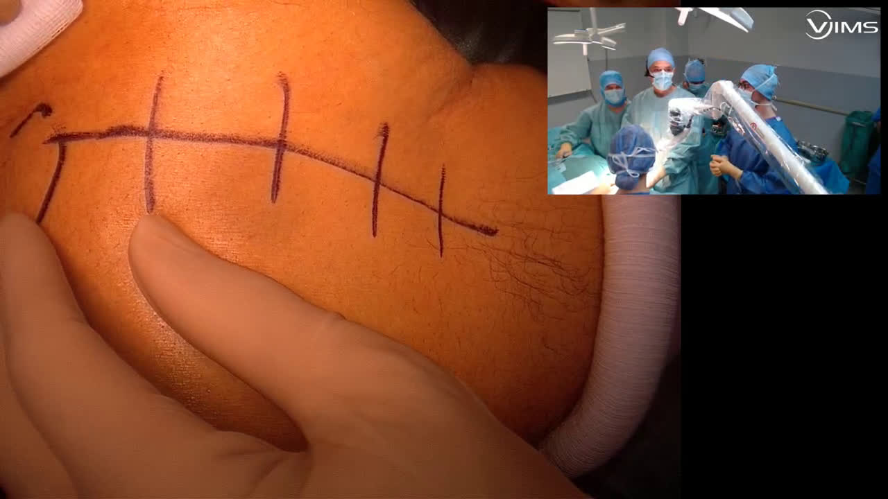 Total reverse shoulder arthroplasty (Dr. Kany)