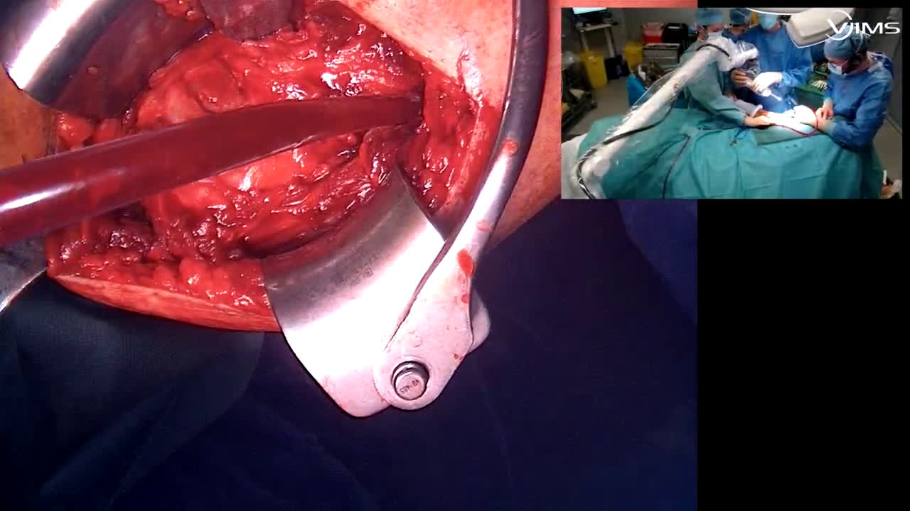 Arrow: advantage of the platform in the recovery of anatomical shoulder prothesis (Dr. Kany)