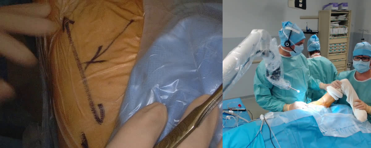 Latissimus Dorsi Transfer and Subscapularis Tear (Dr. Kany)
