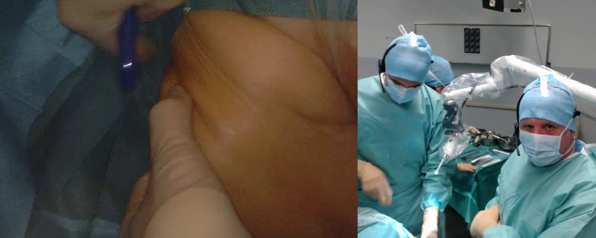 Prothèse inversée de l'Épaule (Dr. Kany)
