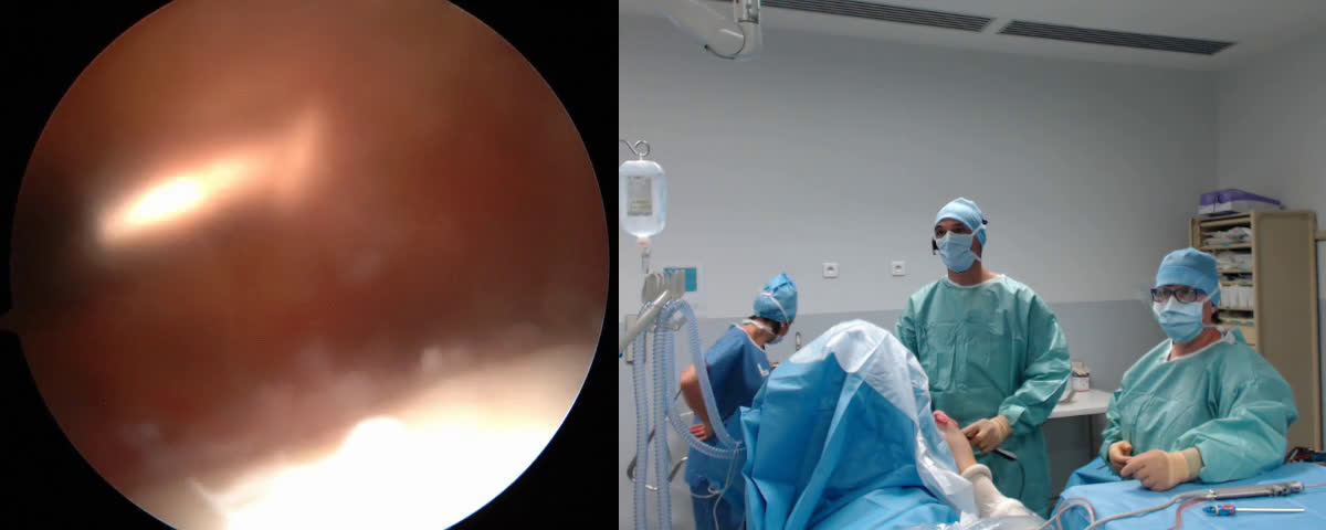 @LHB Key Hole tenodesis technique and reverse L shaped massive supraspinatus tear (Dr. Kany)