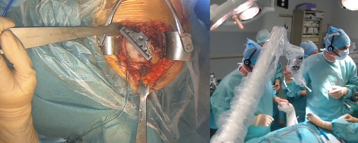 Total Shoulder Arthroplasty (Dr. Kany)