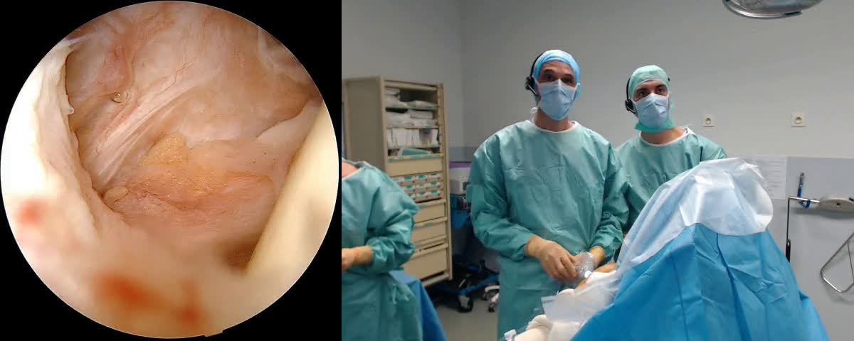 Massive Rotator Cuff Repair (with Olivier Flamand from Mons) (Dr. Kany)