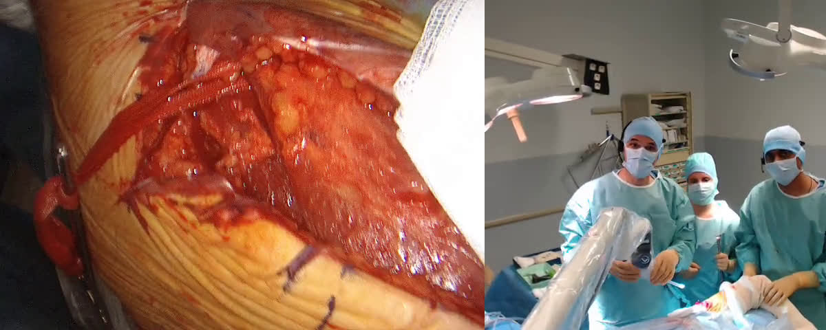 Arthroscopic assisted Latissimus Dorsi Transfer (with Dr. Belliappa Codanda from Bangalore, India) (Dr. Kany)