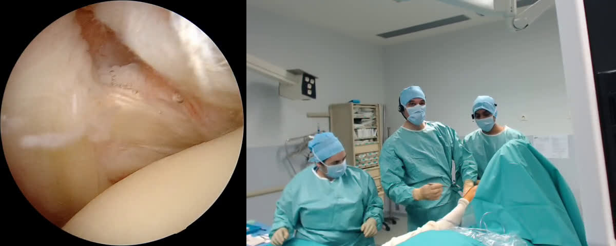 Massive Rotator Cuff Tear - Partial Repair (with Dr. Belliappa Codanda from Bangalore, India) (Dr. Kany)