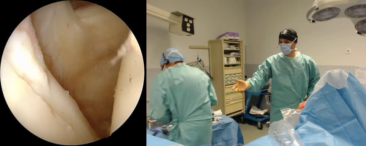 @Classic Latarjet Procedure without Glenoid Bone loss (Dr. Kany)