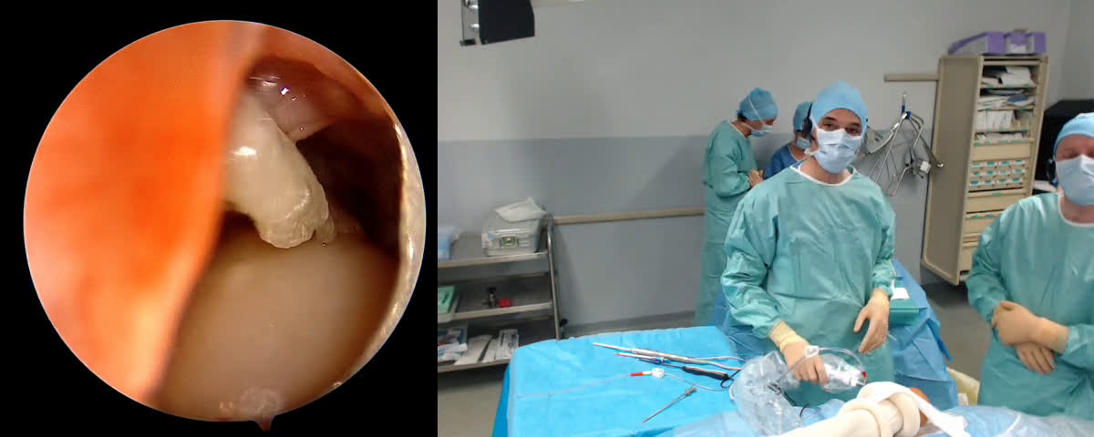 @Key Hole. Rotator cuff repair with VIMS Anchors feat. Dr Slawek Struzik from Warsaw (Poland) (Dr. Kany)
