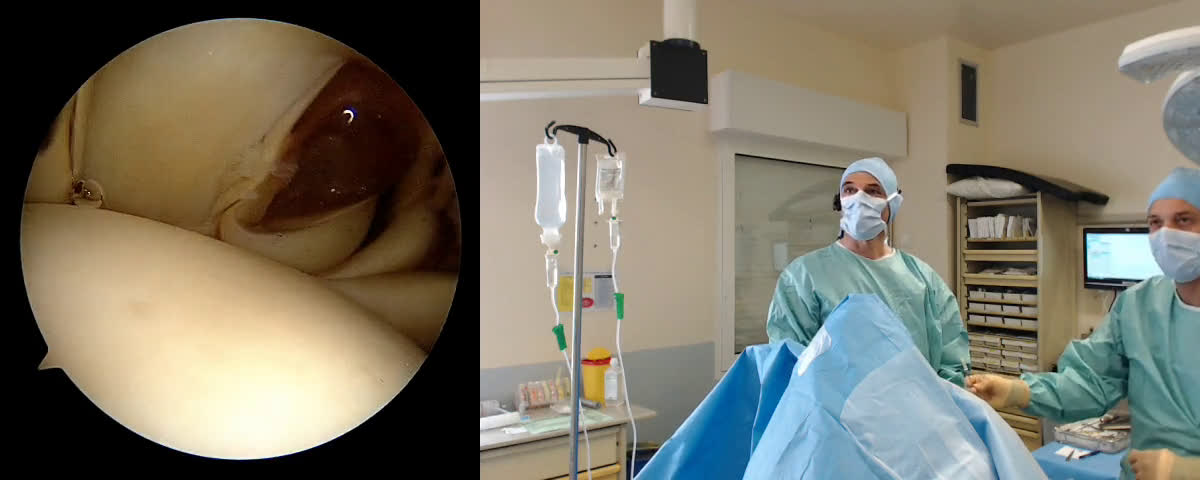 Acute AC joint dislocation: ZipTight 3.2×3.2 with Dr Slawek Struzik from Warsaw (Poland) (Dr. Kany)