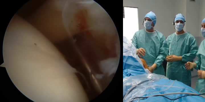 Arthroscopic Latarjet Procedure (with Dr. Olivier Flamand) (Dr. Kany)