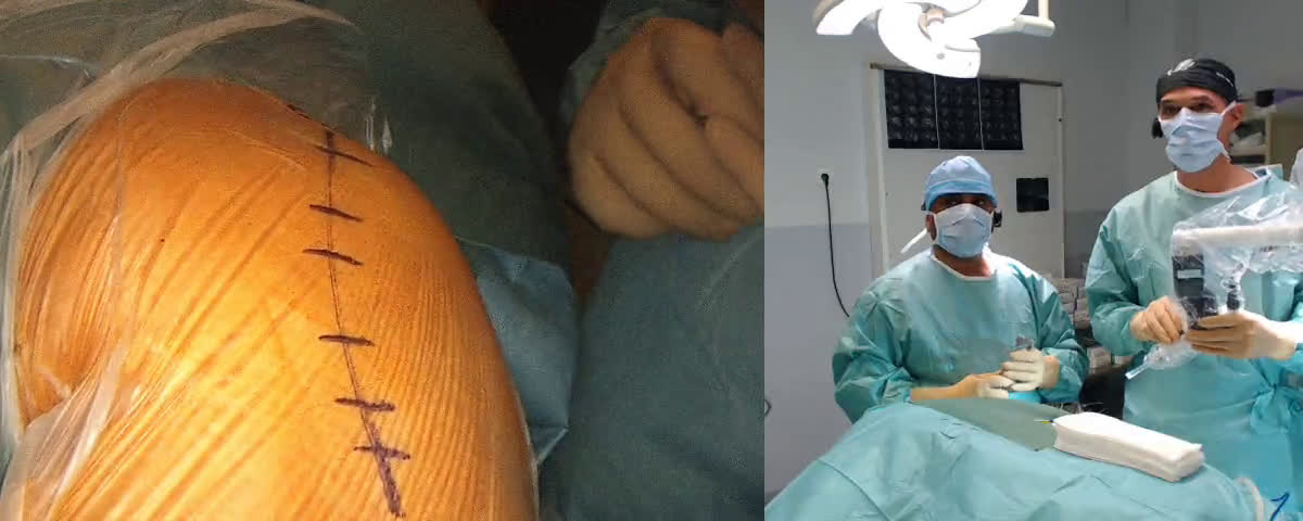 Total Shoulder Arthroplasty. The Arrow solution with Dr. Jijo Jose (Dr. Kany)