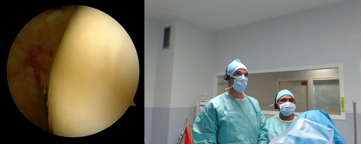 Massive Rotator Cuff Tear. First step to Latissimus Dorsi transfer with Dr. Jijo Jose (Dr. Kany)