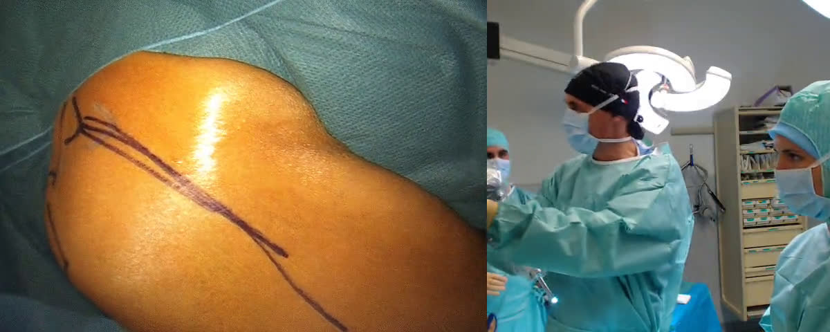Anatomic Shoulder Arthroplasty - FH Arrow Solution (Dr. Kany)