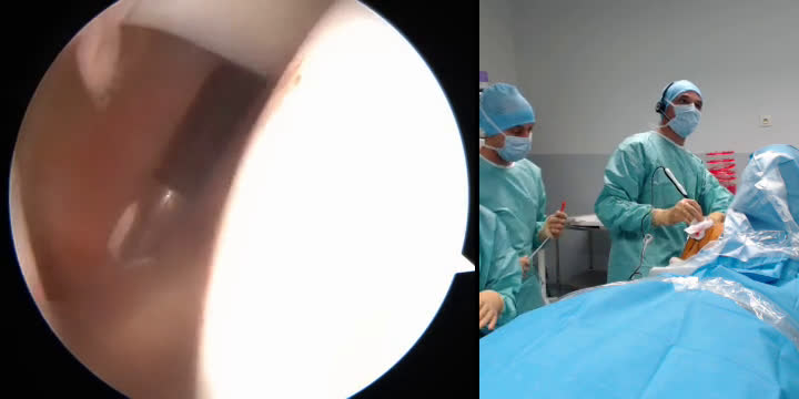 Arthroscopic Latarjet and Remplissage Procedure (with Dr. Olivier Flamand) (Dr. Kany)