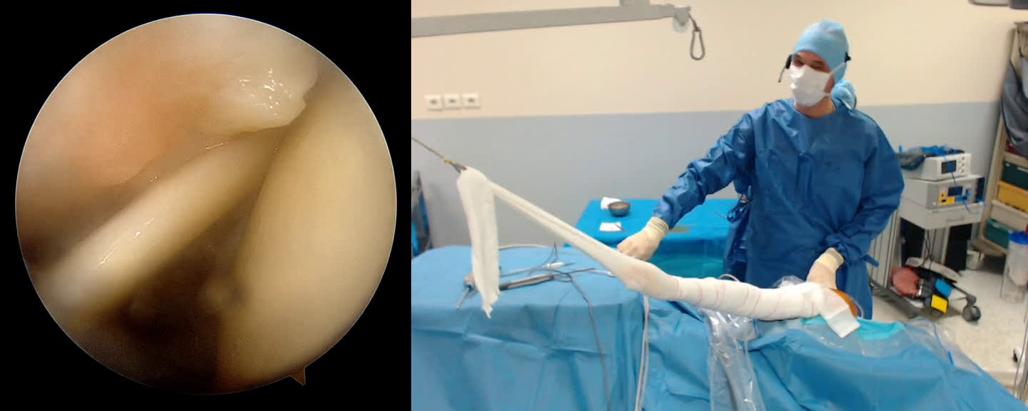 Rotator Cuff tear with Biceps Tenodesis from Clinique du Parc - Toulouse (Dr. Kany)