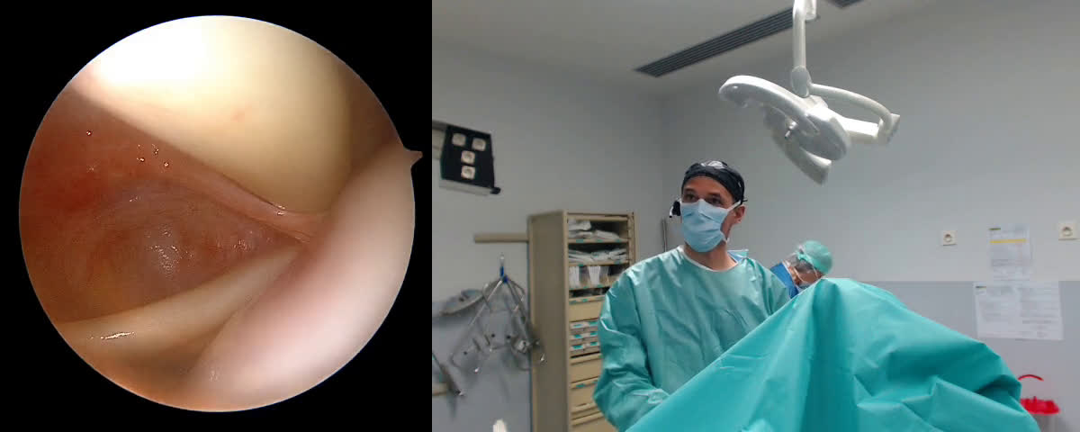 Weaver–Dunn procedure with Dog bone "Y" design (Dr. Kany)