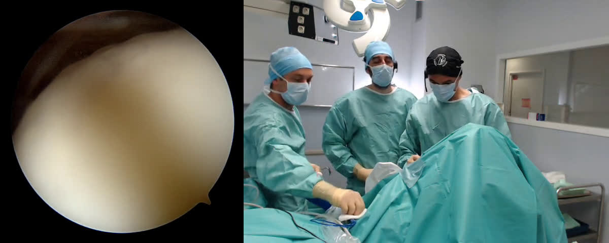 @Latissimus Dorsi Transfer with Cuff repair - with Dr. Scorpie (Dr. Kany)
