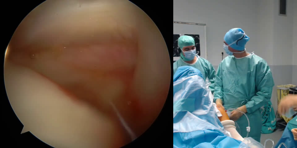 Massive Supraspinatus Tear (with Dr. Olivier Flamand) (Dr. Kany)