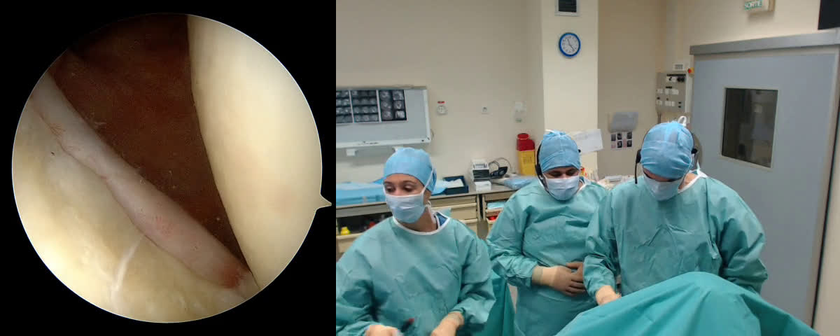 Proximal Subscap tear with Dr Hisham Anis from Le Caire (Dr. Kany)