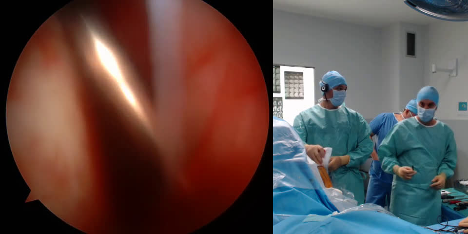 Arthroscopic Latarjet Procedure (with Dr. Olivier Flamand) (Dr. Kany)