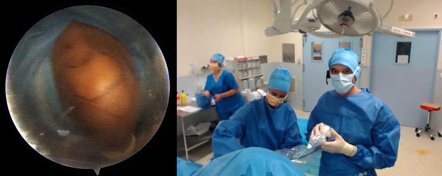 Spinoglenoid cyst: résection, biceps tenodesis and suprascapular nerve release (Dr. Kany)