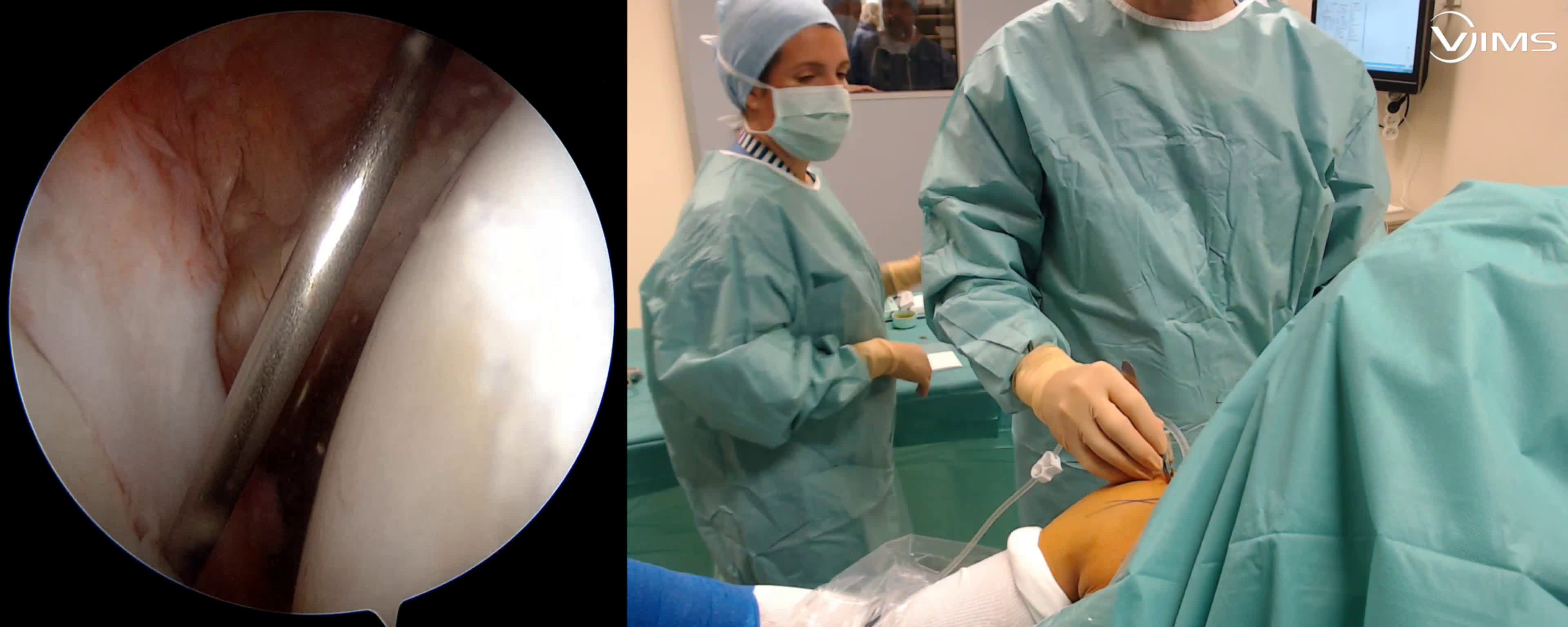 Arthroscopic @Latarjet (difficult) (Dr. Kany)