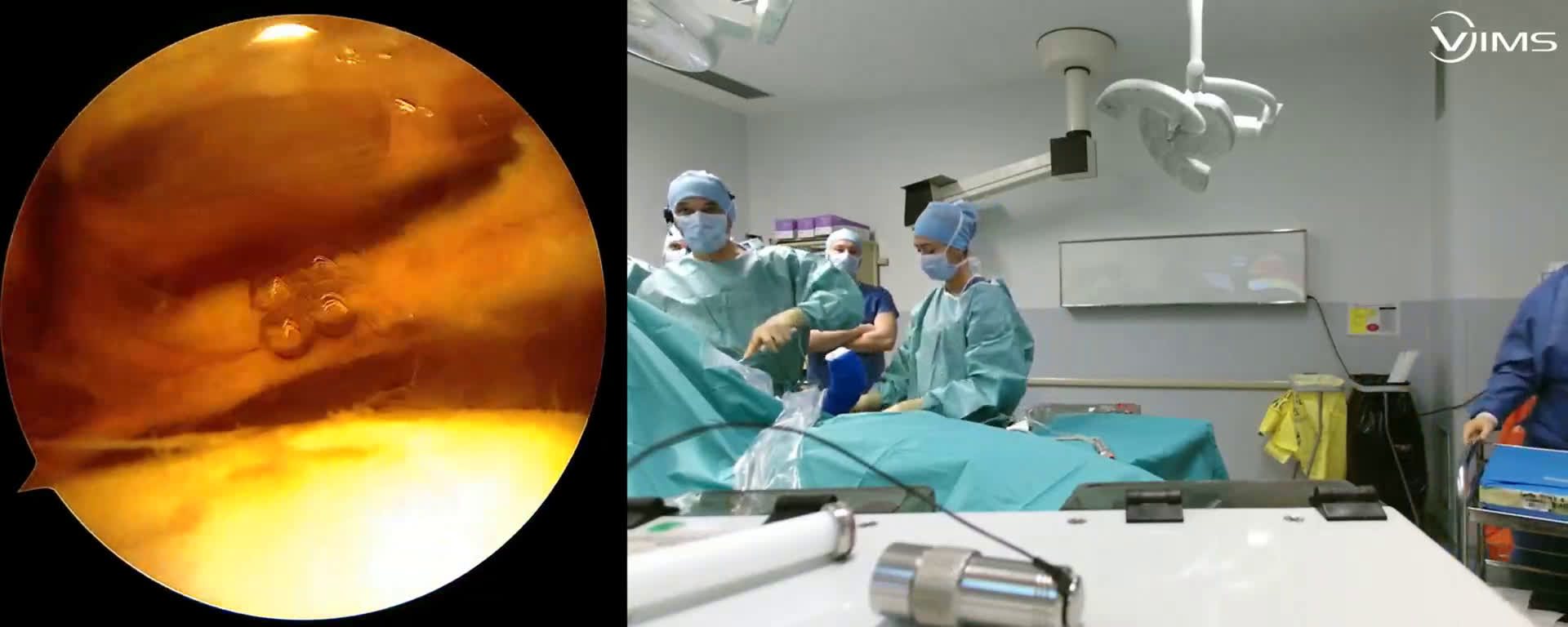 @-full combined LD/TM transfer with Subscap repair wit Dr Vlad Gordins (Sweden) (Dr. Kany)
