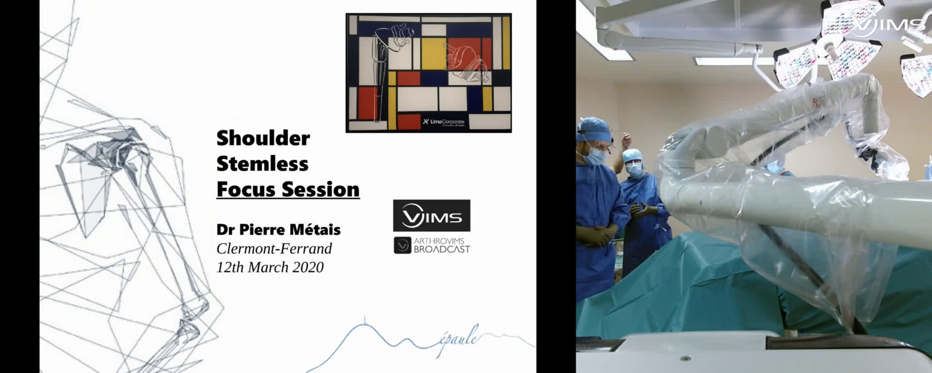 Pierre Métais - RSA stemless revision for glenoid loosening - Dr Zico ...