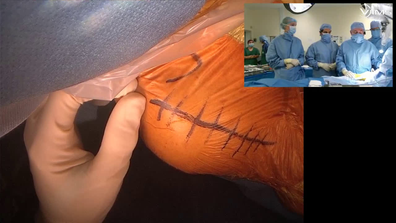 Reverse shoulder arthroplasty for cuff tear arthropathie (Dr. Valenti)