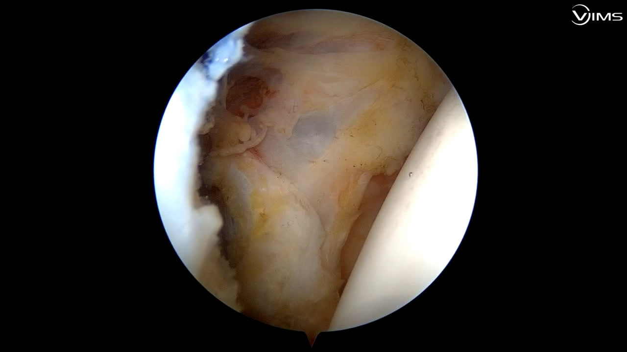 Bankart + Bone augmentation with button fixation full arthroscopy teenager (Dr. Valenti)