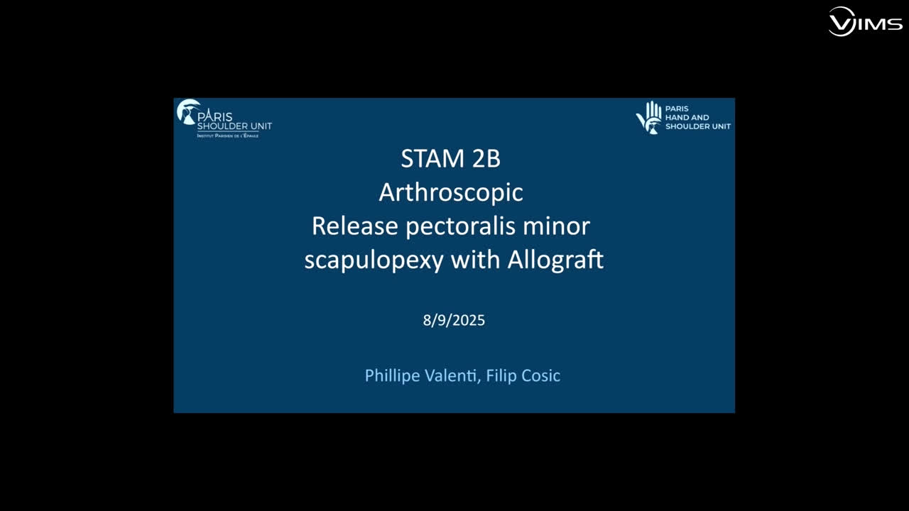 Arthroscopic release pectoralis minor scapulopexy with allograft (Dr. Valenti)
