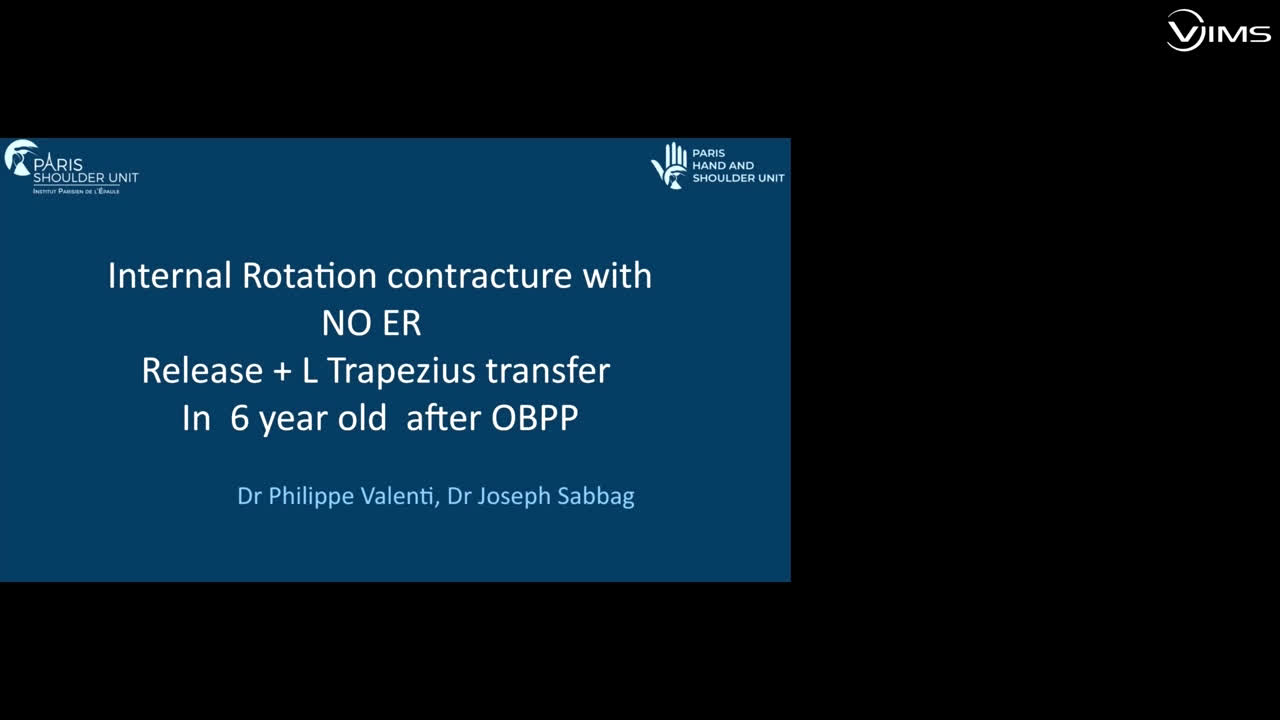 Release + L Trapezius transfer (Dr. Valenti)