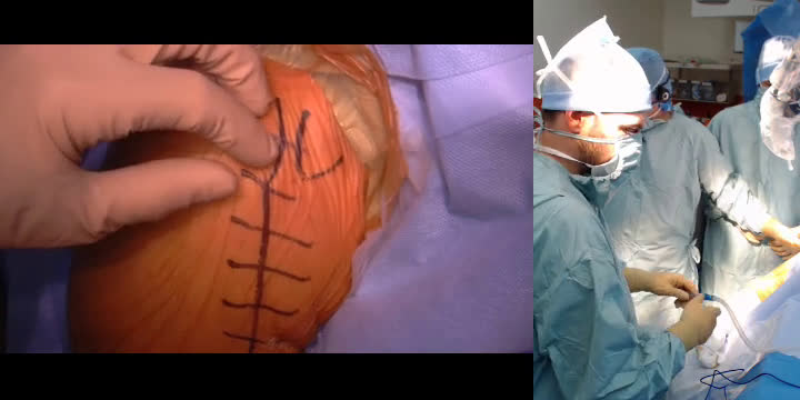 Live Surgery (Dr. Valenti)