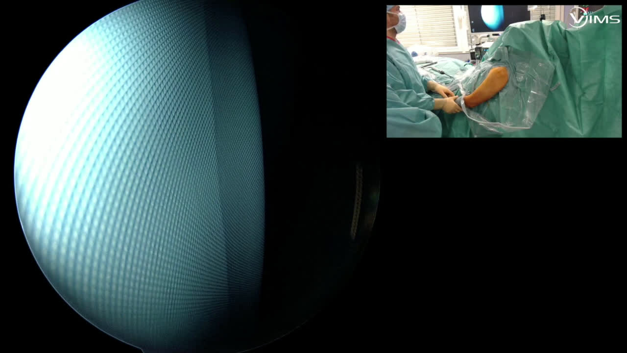 Massive Subscapularis repair from inside the Box (Dr. Lafosse)