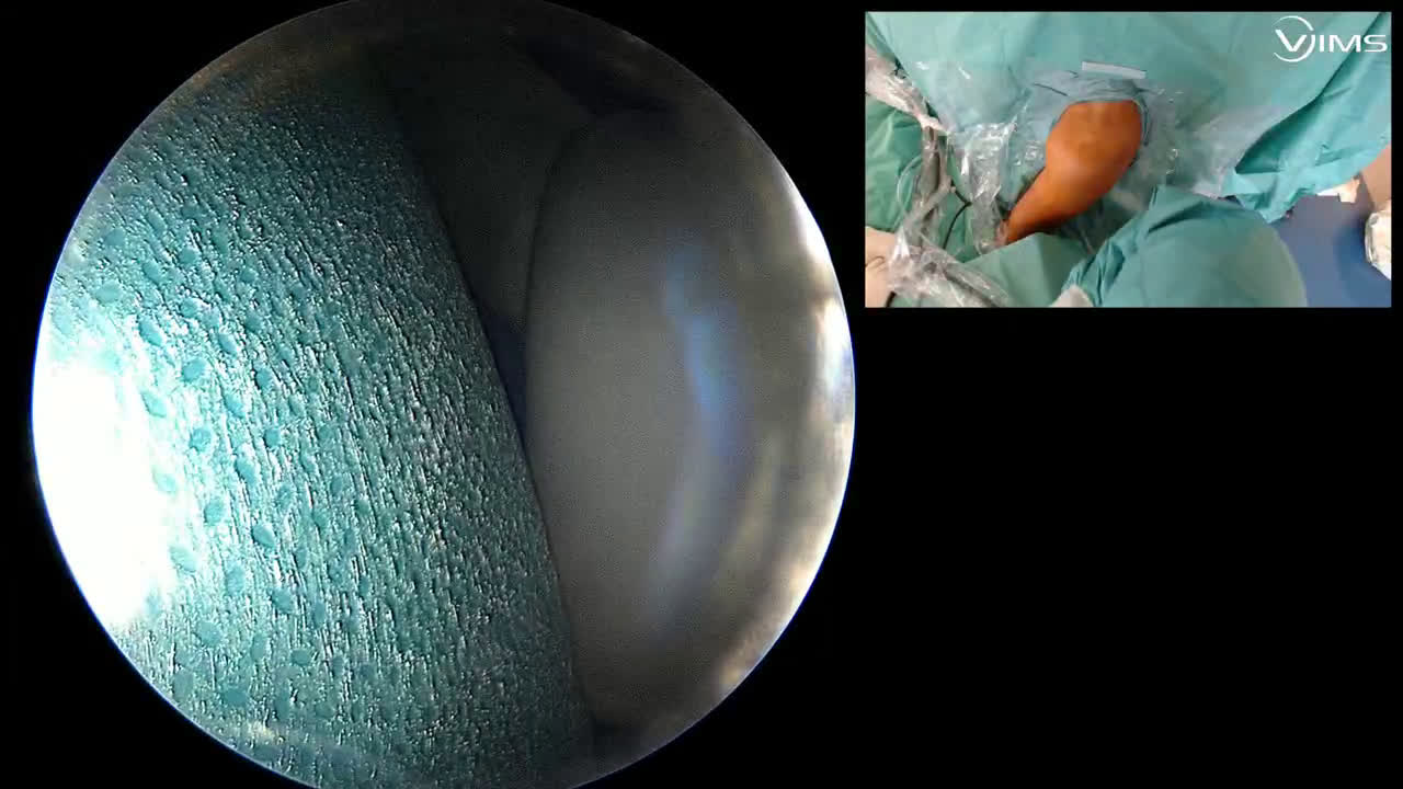 Réparation arthroscopique de ligaments coraco-claviculaire pour dysjonction acromio-claviculaire (Dr. Lafosse)