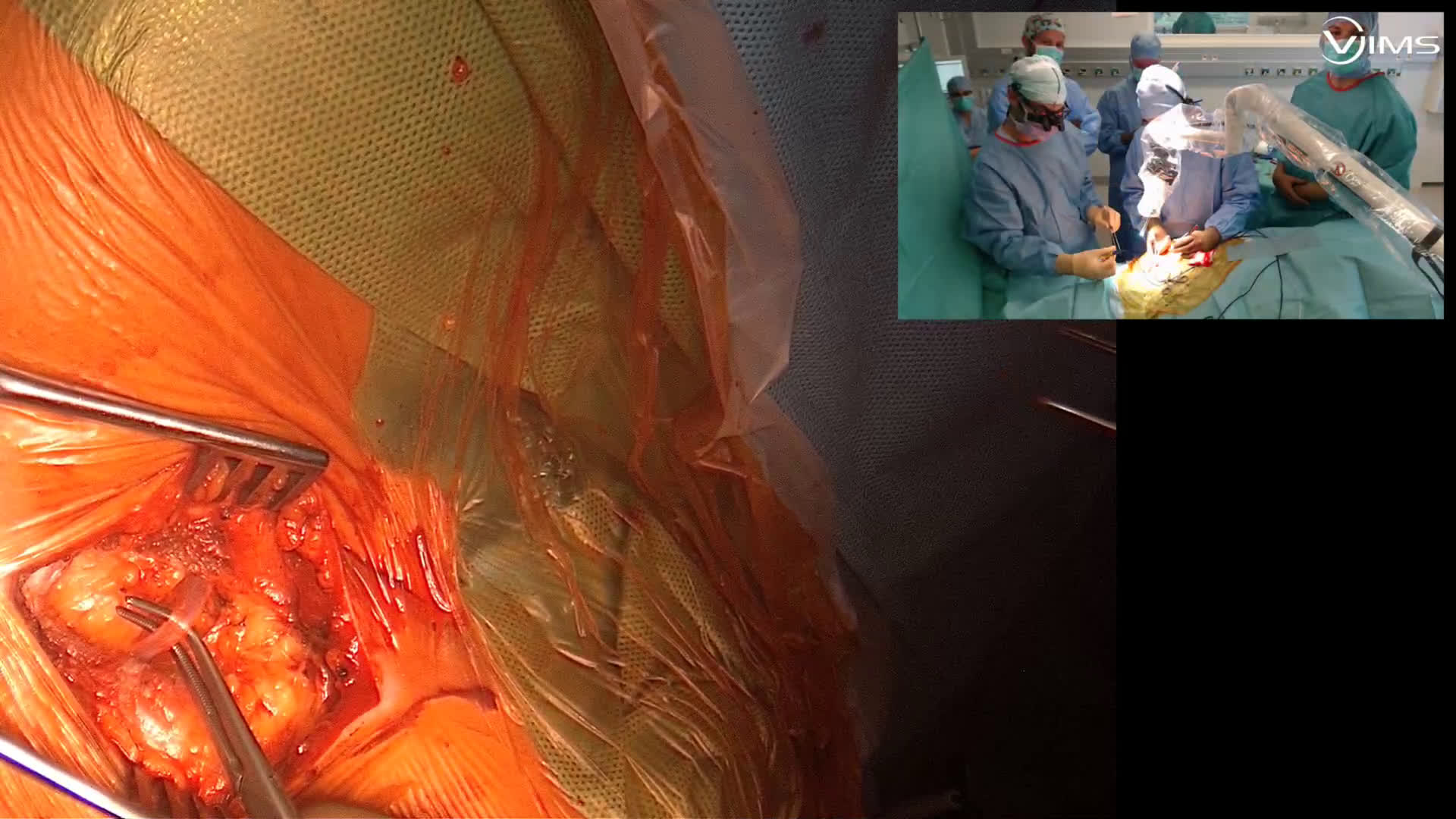 Résection de première côte et scalenectomie pour syndrome du défilé  (Dr. Lafosse)