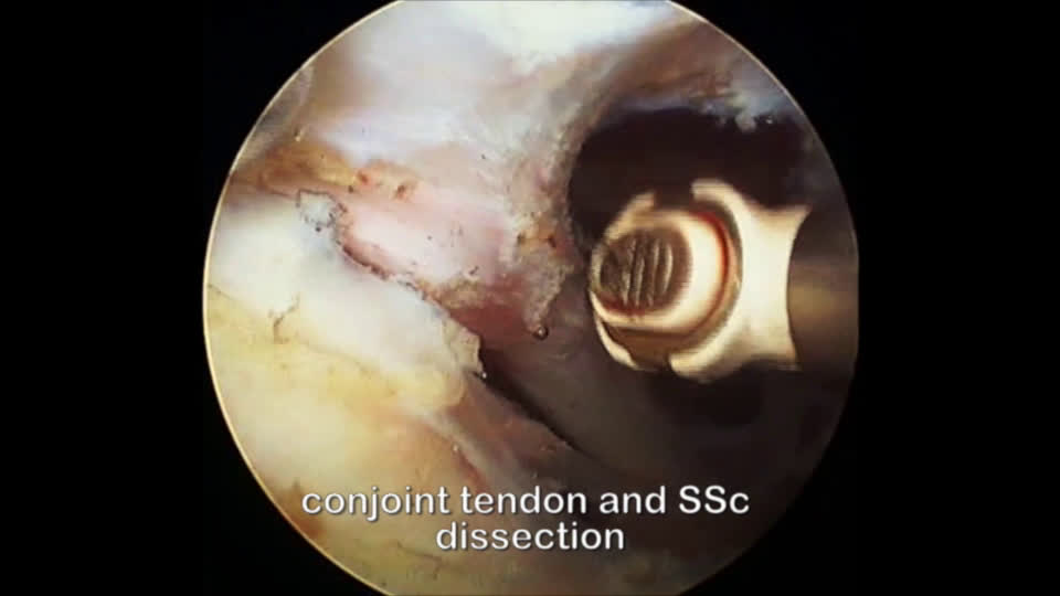 All-endoscopic Brachial Plexus Complete Neurolysis for Idiopathic Neurogenic Thoracic Outlet Syndrome: Surgical Technique (Dr. Lafosse)