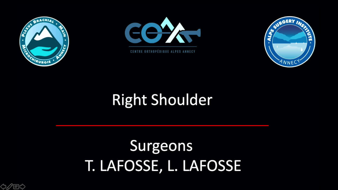 Arthroscopic Latissimus dorsi transfer for irreparable subscapularis tear (Dr. Lafosse)